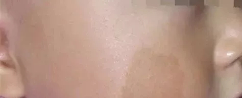 咖啡斑需要治疗几次