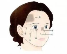 太田痣有哪些典型症状