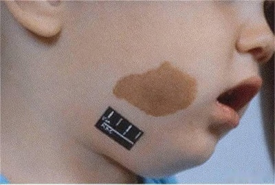 胎记是怎么引起的？