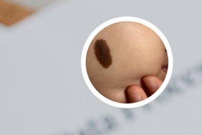 黑毛痣是怎么形成的？